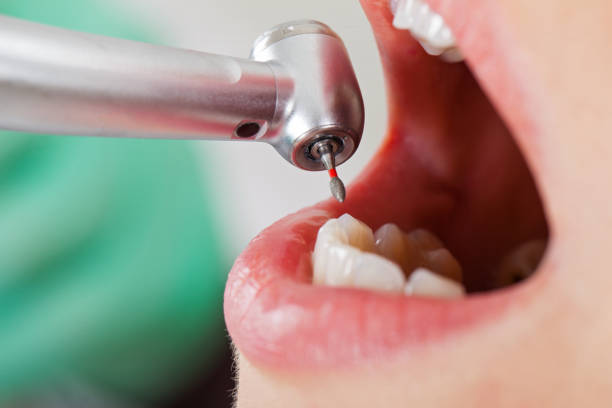 Best Dentist for Tooth Abscess  in San Pablo, NM